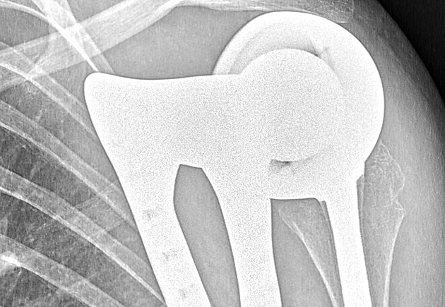 Unikátní operace v Motole. Chlapec má díky 3D tisku funkční lopatku